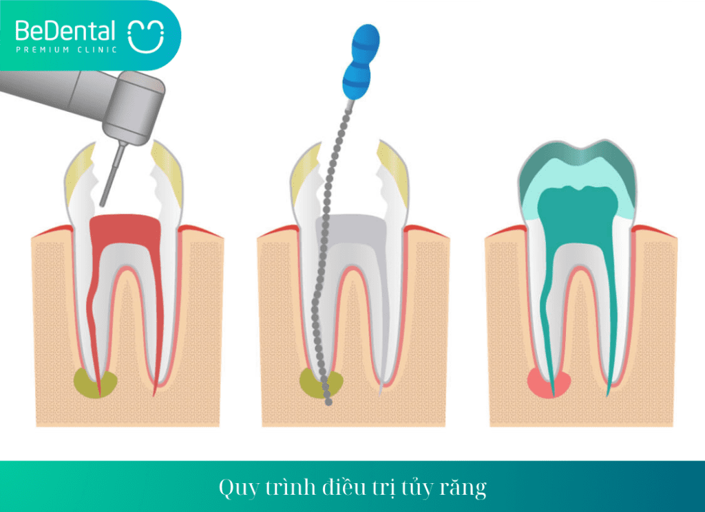 Quy trình điều trị tủy răng