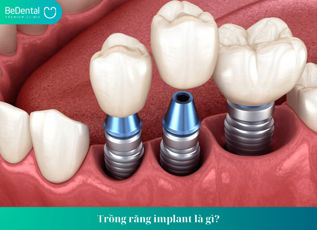 Trồng răng implant giữ được bao lâu?Cách kéo dài tuổi thọ của implant