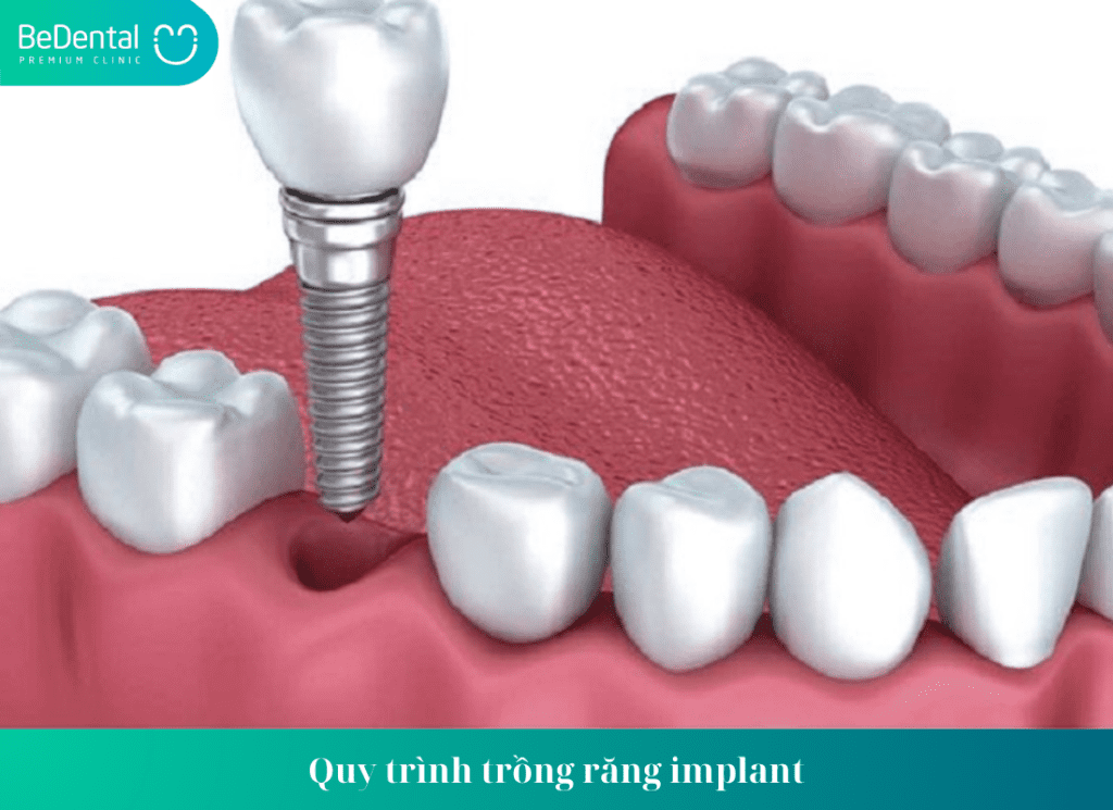 Trồng răng implant giữ được bao lâu?Cách kéo dài tuổi thọ của implant