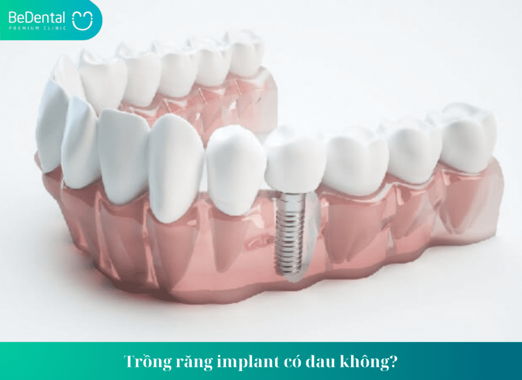 Trồng răng implant giữ được bao lâu?Cách kéo dài tuổi thọ của implant