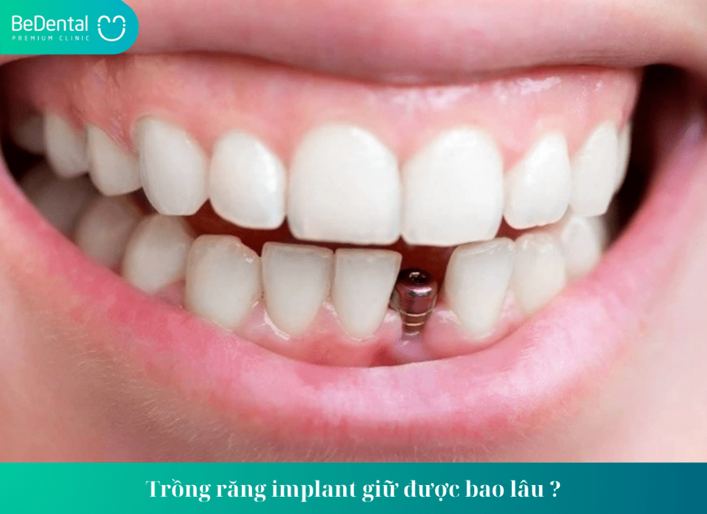 Trồng răng implant giữ được bao lâu?Cách kéo dài tuổi thọ của implant