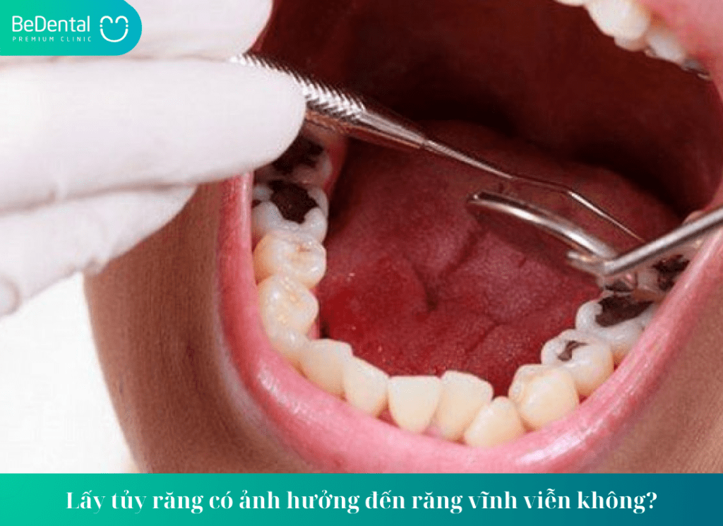 Lấy tủy răng có ảnh hưởng đến răng vĩnh viễn không?