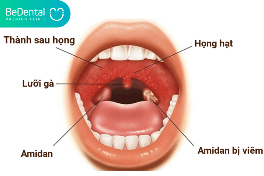Viêm họng hạt là gì? Nguyên nhân chính gây ra viêm họng hạt