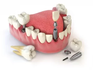 trong rang implant fast 3d e1533545732646