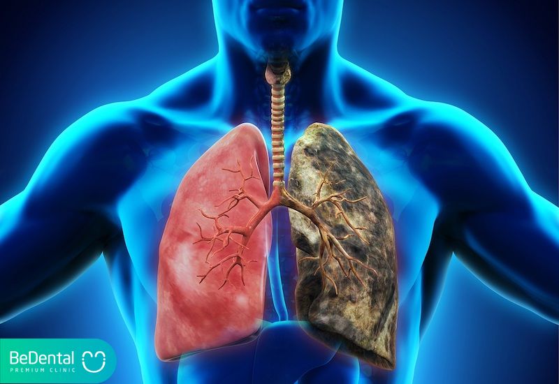bệnh ung thư phổi