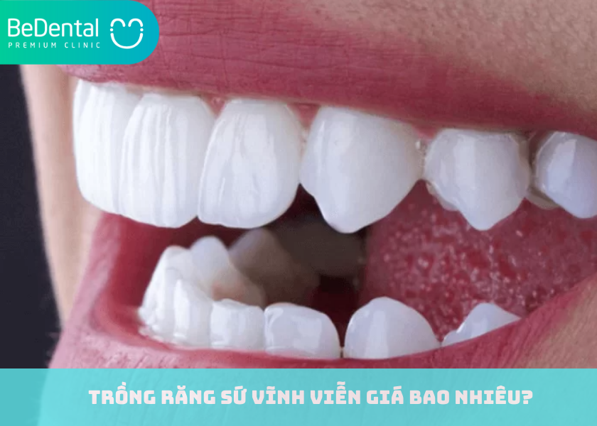 Trồng răng sứ vĩnh viễn giá bao nhiêu?