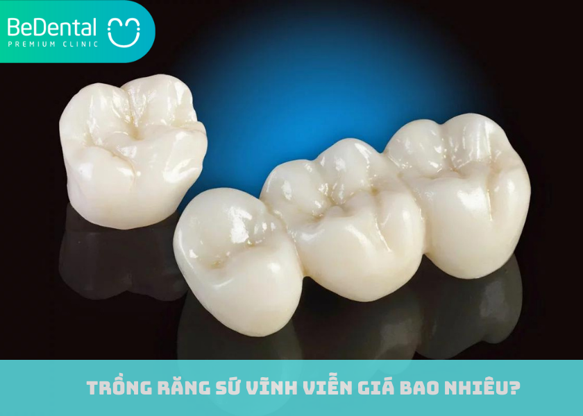 Trồng răng sứ vĩnh viễn giá bao nhiêu?