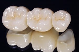 Vậy trồng răng sứ vĩnh viễn giá bao nhiêu? Những trường hợp nào không nên trồng răng sứ vĩnh viễn?