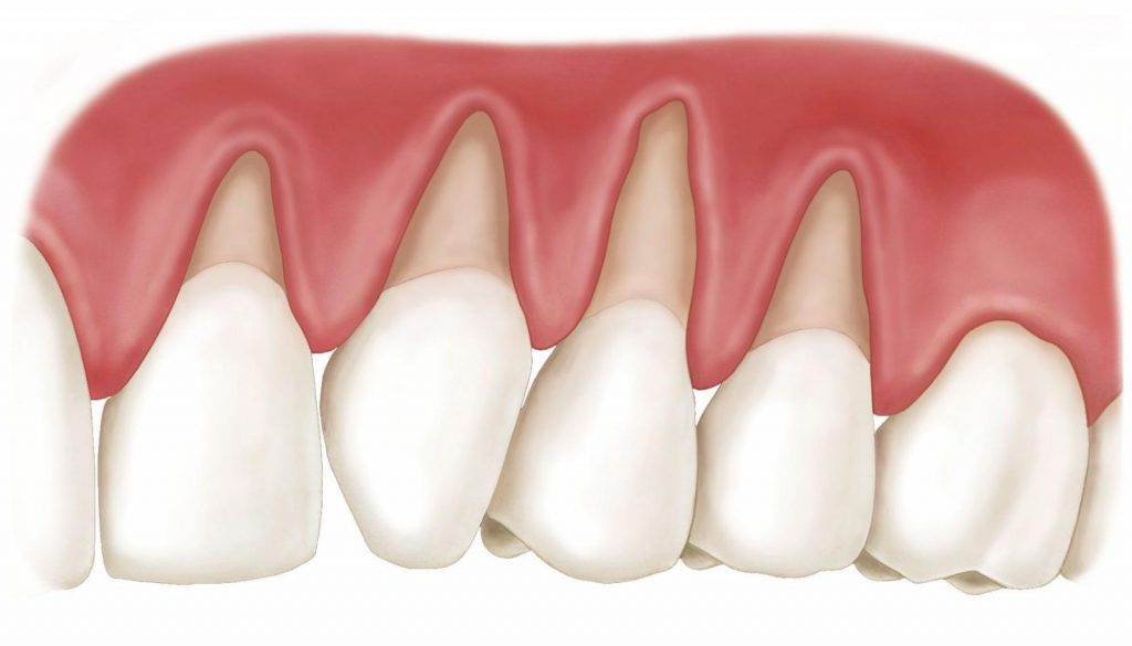 Tụt Lợi Khi Niềng Răng và 1 Số Cách Khắc Phục
