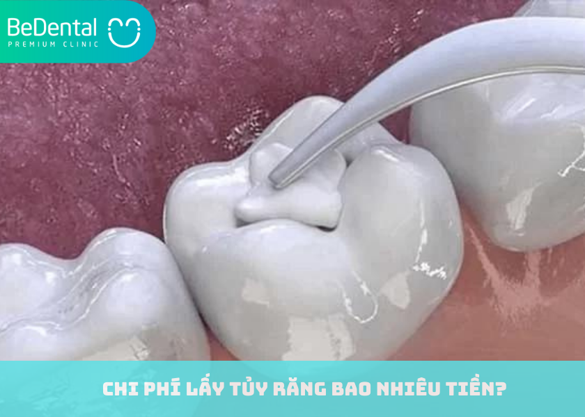 Chi phí lấy tủy răng bao nhiêu tiền ?