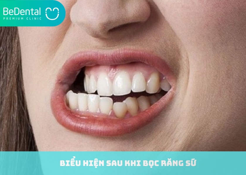 Biểu hiện sau khi bọc răng sứ