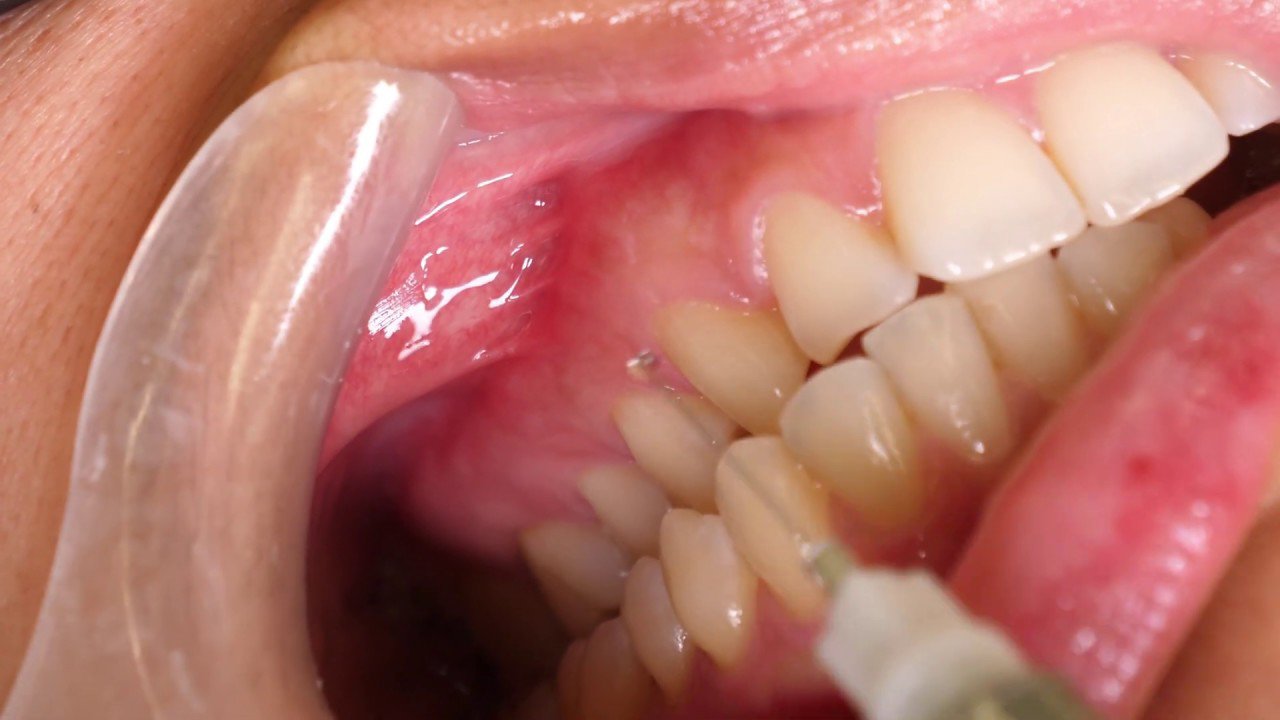 Nhổ răng khôn gây mê hay gây tê có tác dụng gì?