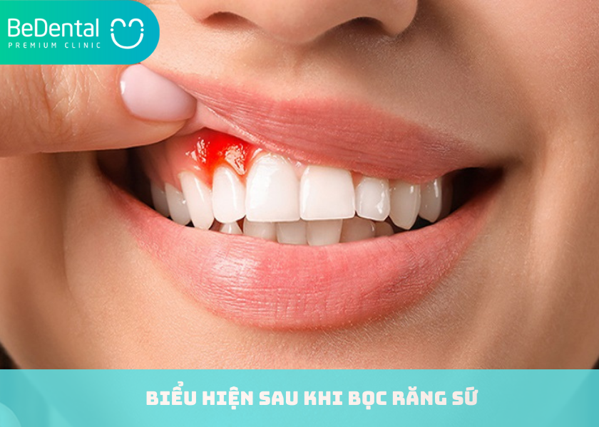 Biểu hiện sau khi bọc răng sứ