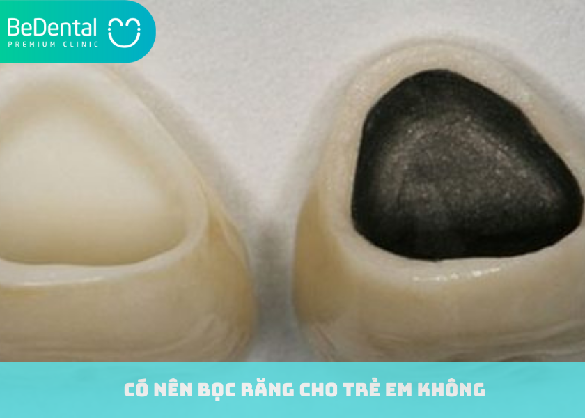 Có nên bọc răng sứ cho trẻ em không