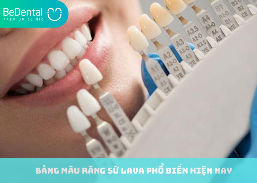 Bảng màu răng sứ Lava phổ biến hiện nay