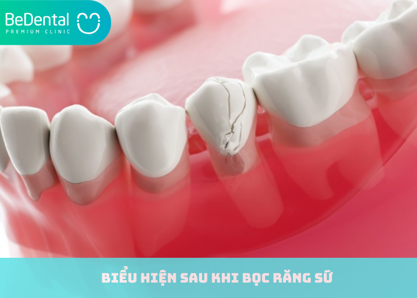 Biểu hiện sau khi bọc răng sứ