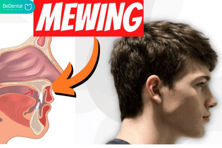 phương pháp mewing
