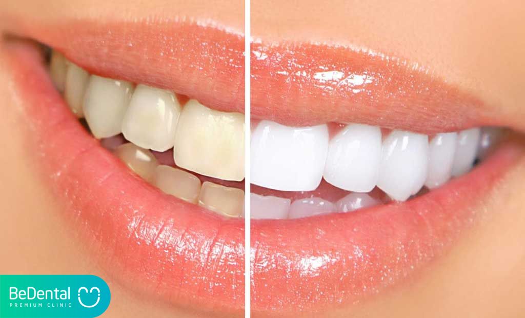 Công nghệ tẩy trắng răng là gì ?