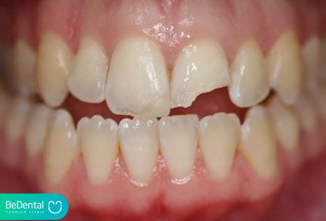 mẻ răng hàm là gì