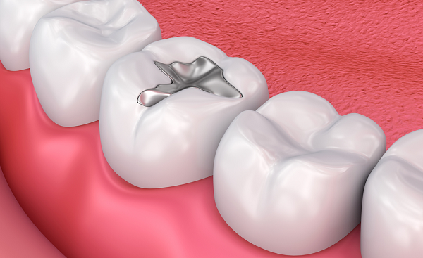 How long do dental fillings last?