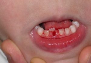  Dấu hiệu giúp nhận biết răng của trẻ bị gãy răng sữa 