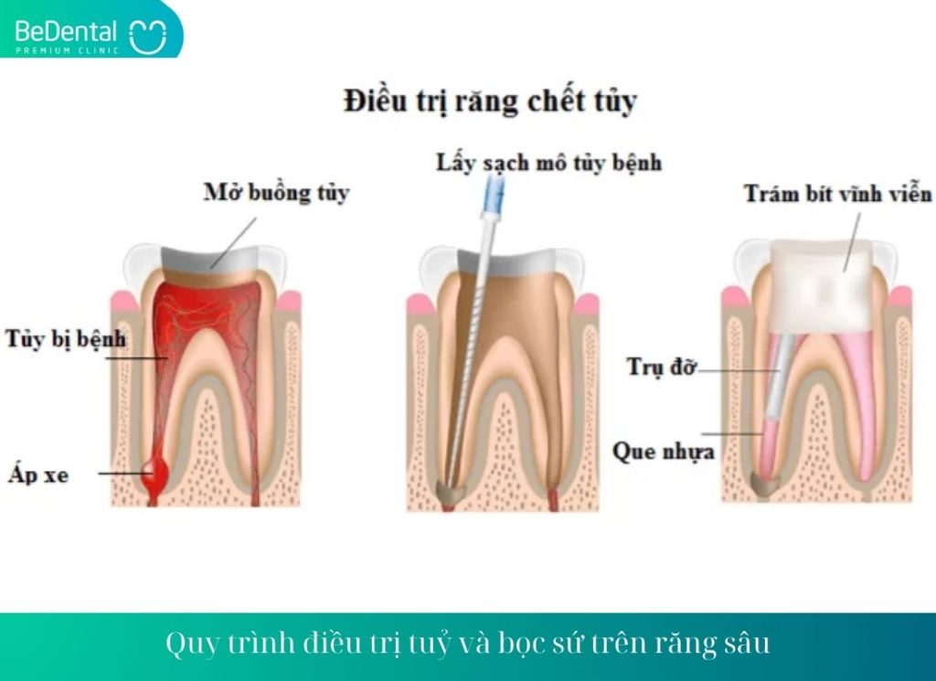 Quy trình điều trị tuỷ và bọc sứ trên răng sâu