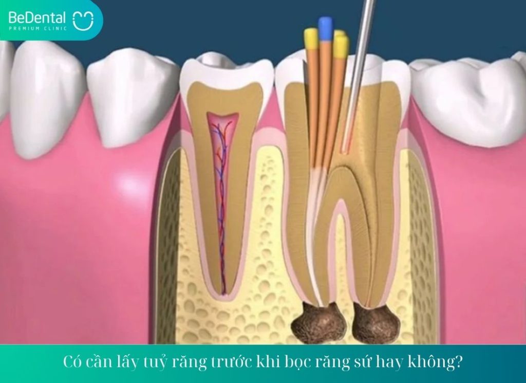 Có cần lấy tuỷ răng trước khi bọc răng sứ hay không?