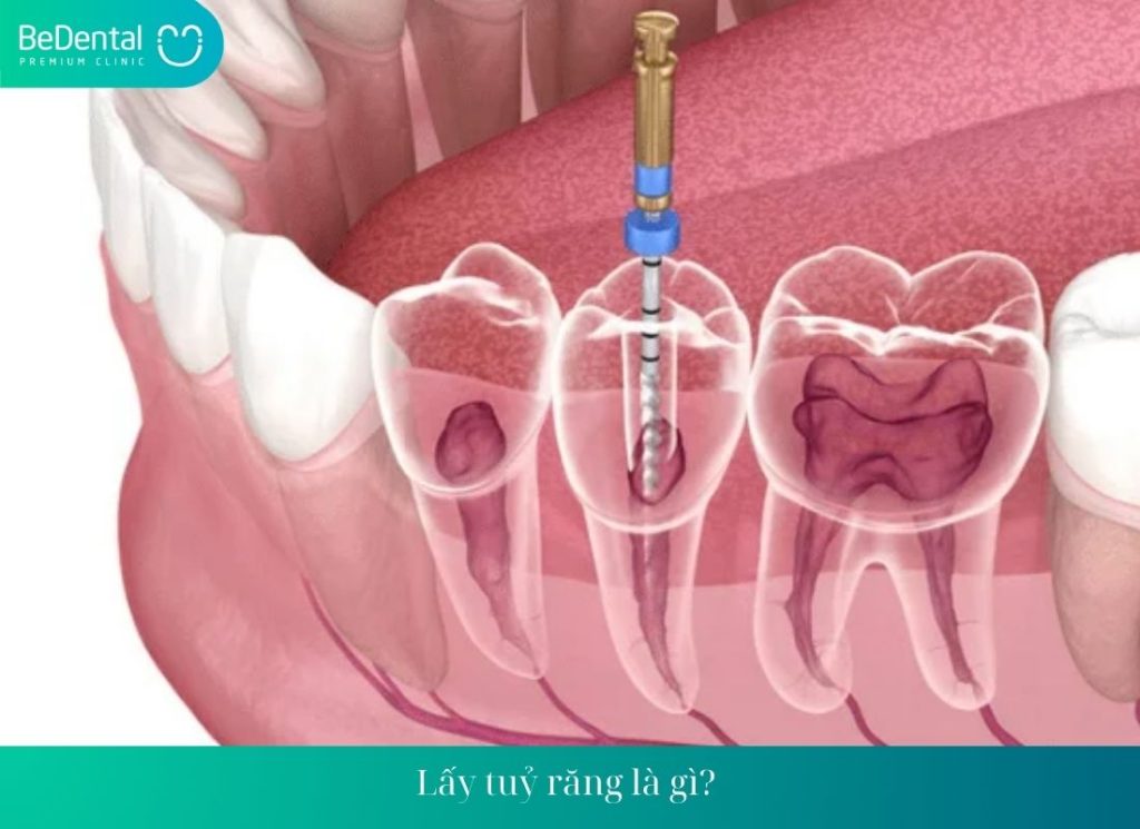 Lấy tuỷ răng là gì? 