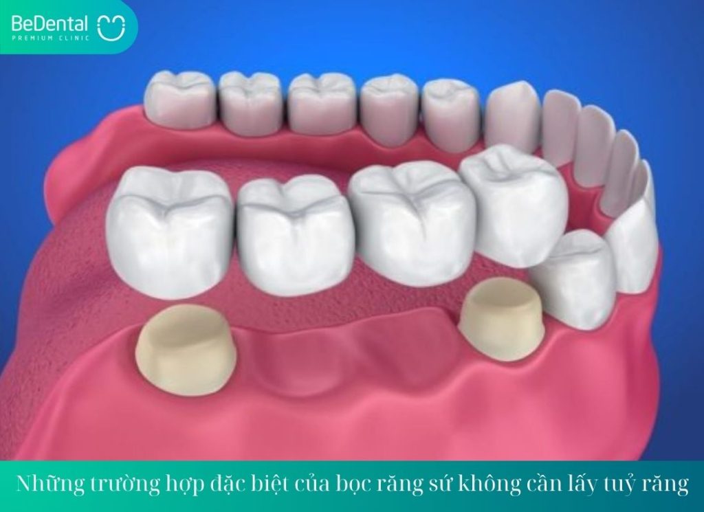 Những trường hợp đặc biệt của bọc răng sứ không cần lấy tuỷ răng