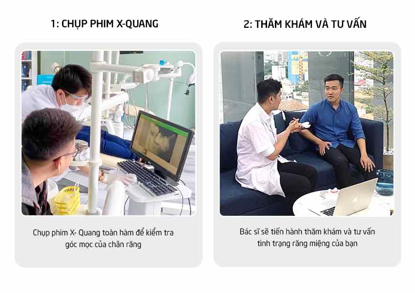 Ưu đãi nhổ răng khôn 7 Quy trinh nho rang 1