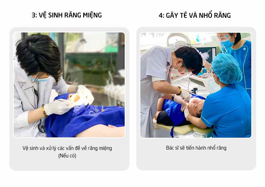 Ưu đãi nhổ răng khôn 8 Quy trinh nho rang 2