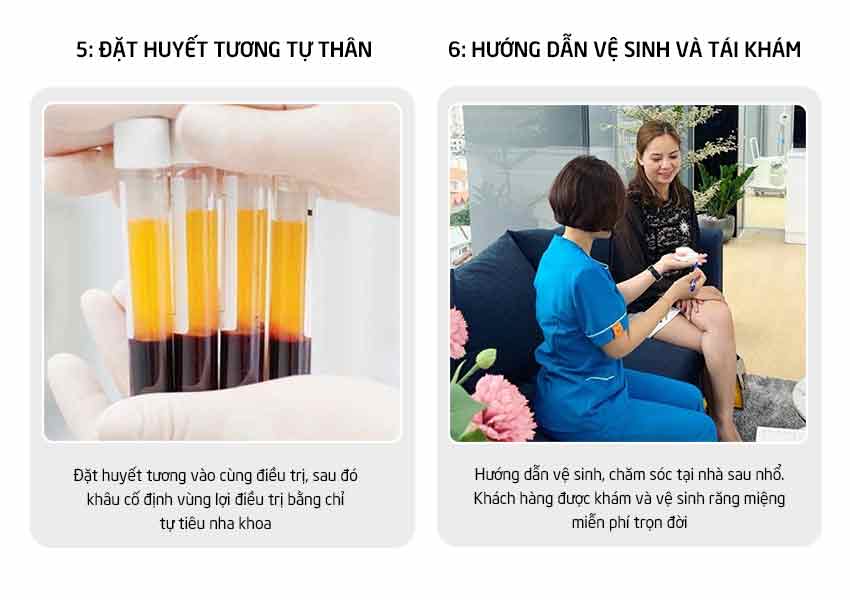 Ưu đãi nhổ răng khôn 9 Quy trinh nho rang 3