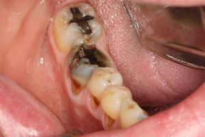 Sâu răng và áp xe răng 