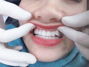 Bọc răng sứ cho răng khểnh 