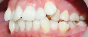 Trường hợp nào cũng nên bọc răng sứ đối với răng khểnh