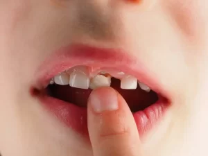 Trẻ bị gãy răng sữa có mọc lại được không 