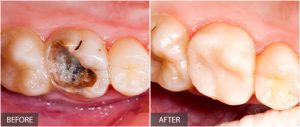  Quy trình điều trị tuỷ và bọc sứ trên răng sâu 