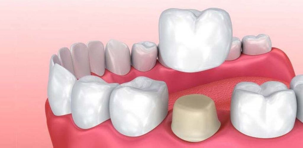 Răng Hàm Mặt Sài Gòn - Tiêu Chuẩn Quốc Tế Với Dịch Vụ Nha Khoa Chuyên Sâu 5 dieu tri tuy rang co nen boc su 2