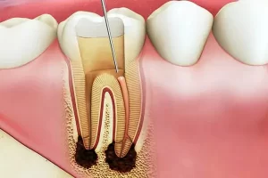 Có cần lấy tuỷ răng trước khi bọc răng sứ hay không