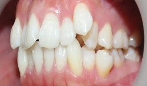 Nguyên nhân niềng răng bị tụt lợi 