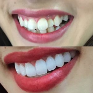 Ưu điểm của phương pháp bọc răng sứ cho răng khểnh 