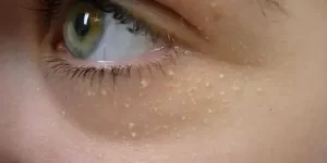 Triệu chứng của mụn cơm quanh mắt 