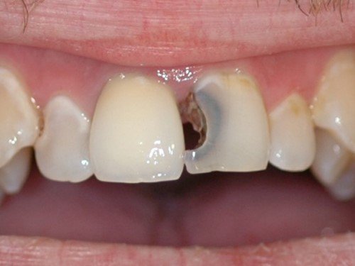 What is cavities between two molars? How to prevent molar cavities? Symptoms of molar interdental caries