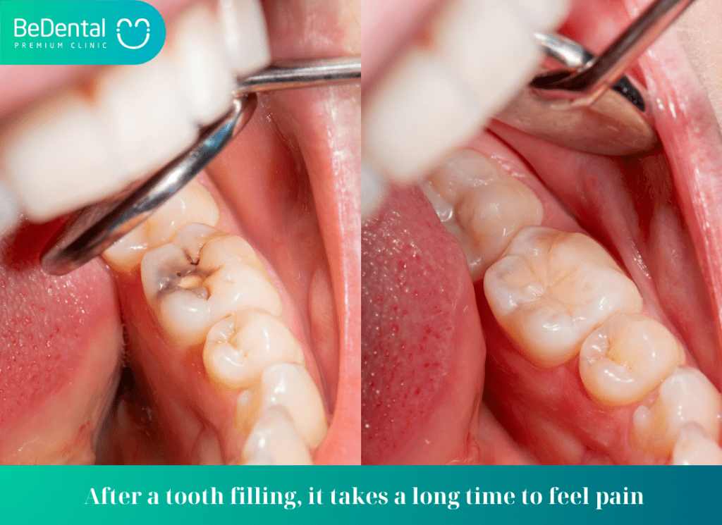 After a tooth filling it takes a long time to feel pain