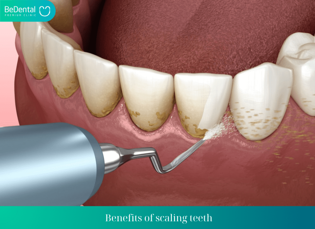 Benefits of scaling teeth