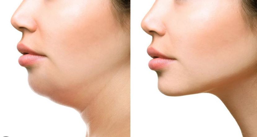 causes of a receding chin