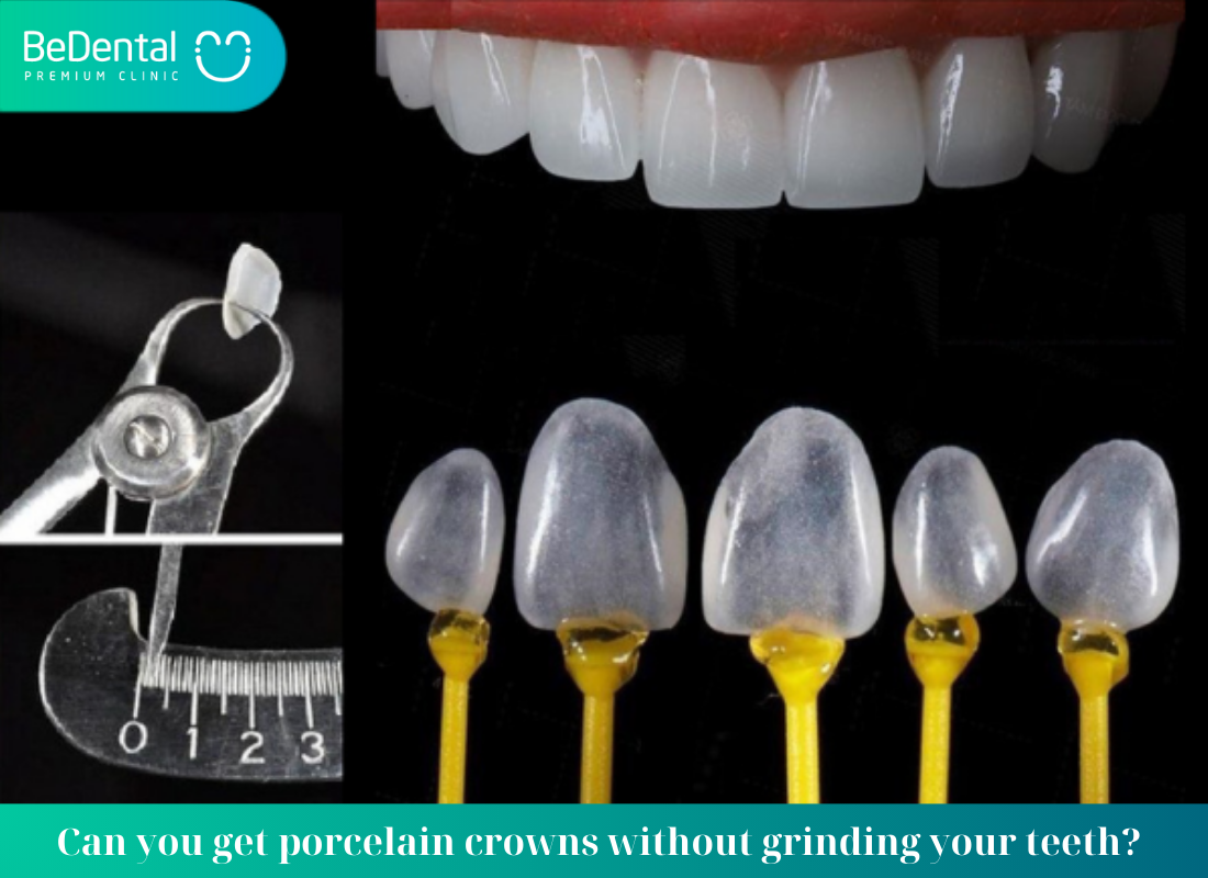 What is a porcelain crown without tooth grinding? What is the price of porcelain crowns without grinding? Does porcelain crown grinding have any effect?