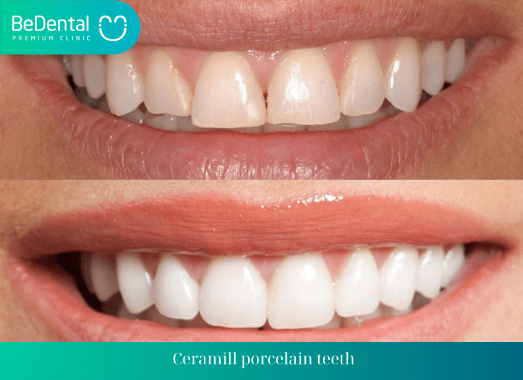 Ceramill porcelain teeth