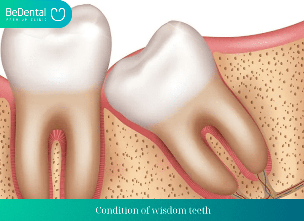 Condition of wisdom teeth