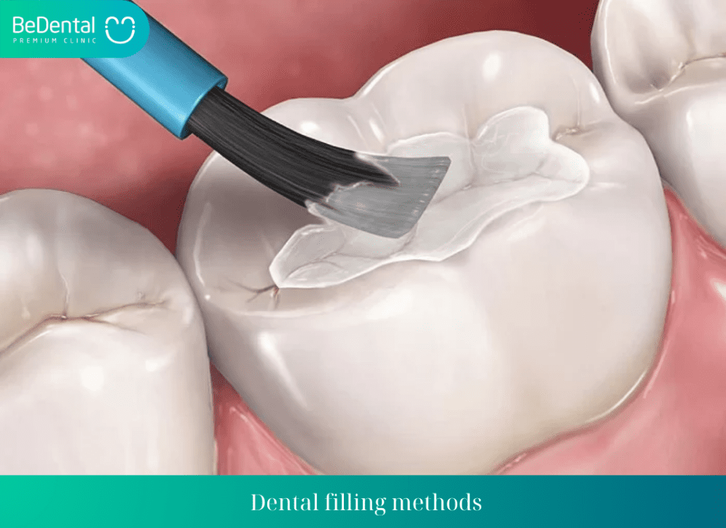 Dental filling method